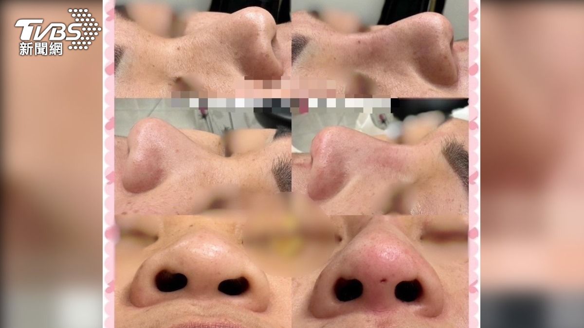 康女放上術前、術後成果對比照吸引消費者。（圖／TVBS）