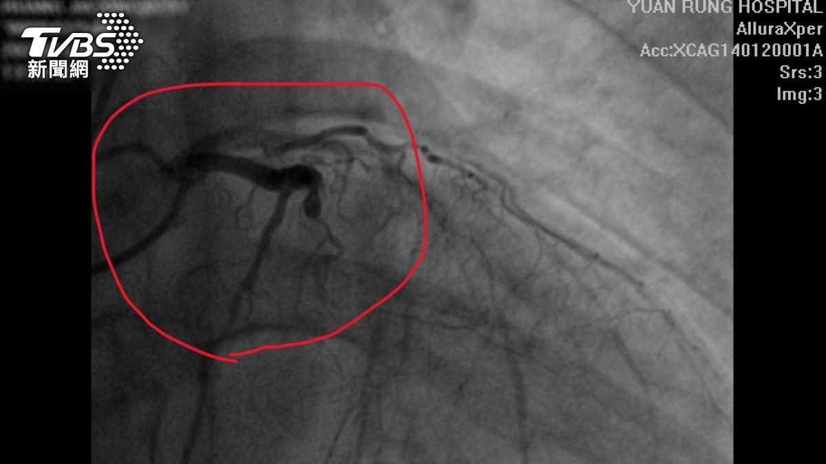 29歲患者因高血壓未服藥，加上生活作息不正常，心臟三根動脈血管都嚴重阻塞。（圖／TVBS）