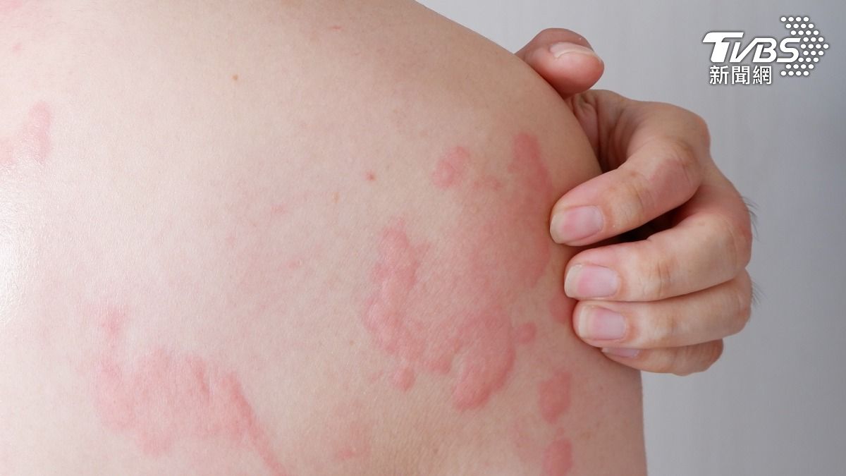 皮膚過敏擦再多乳液也不見得有效。　（示意圖／shutterstock達志影像）
