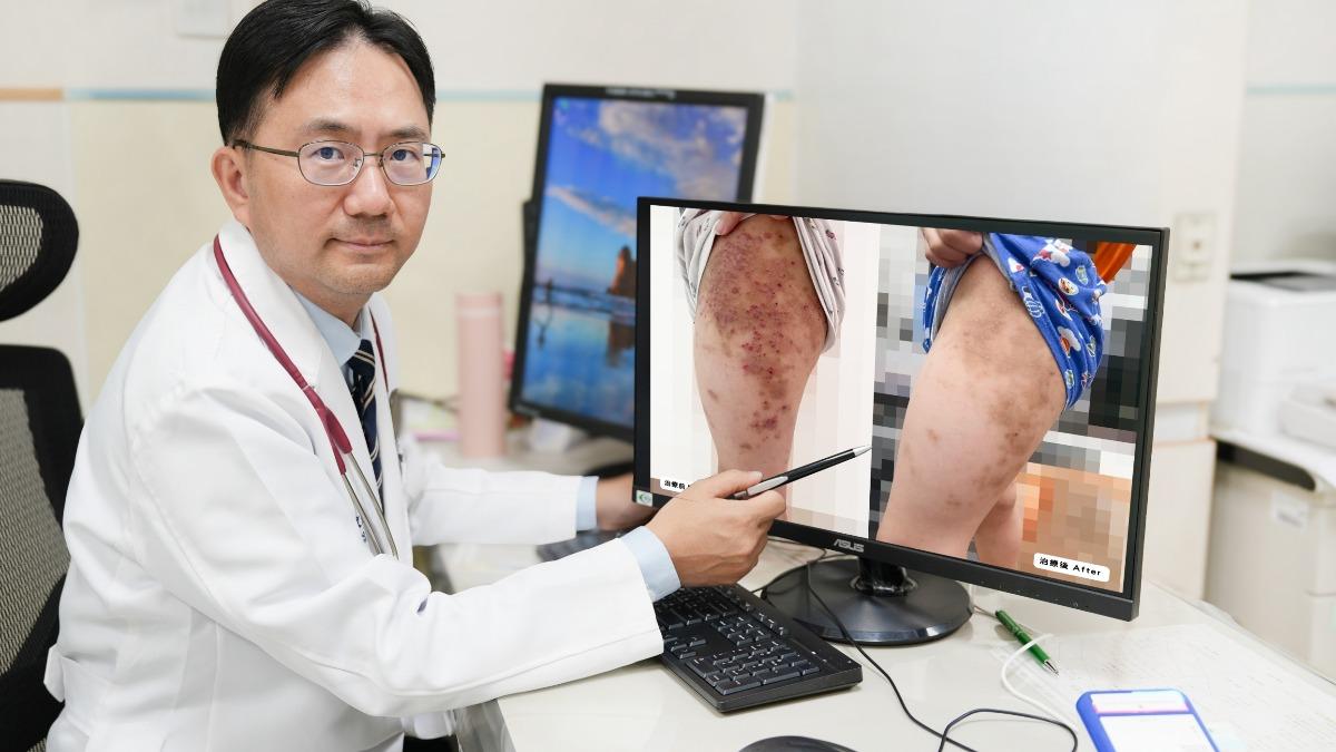楊樹文採取口服免疫抑制劑及外用類固醇藥膏治療，並協助男童申請療程。（圖／中國附醫兒童醫院提供）