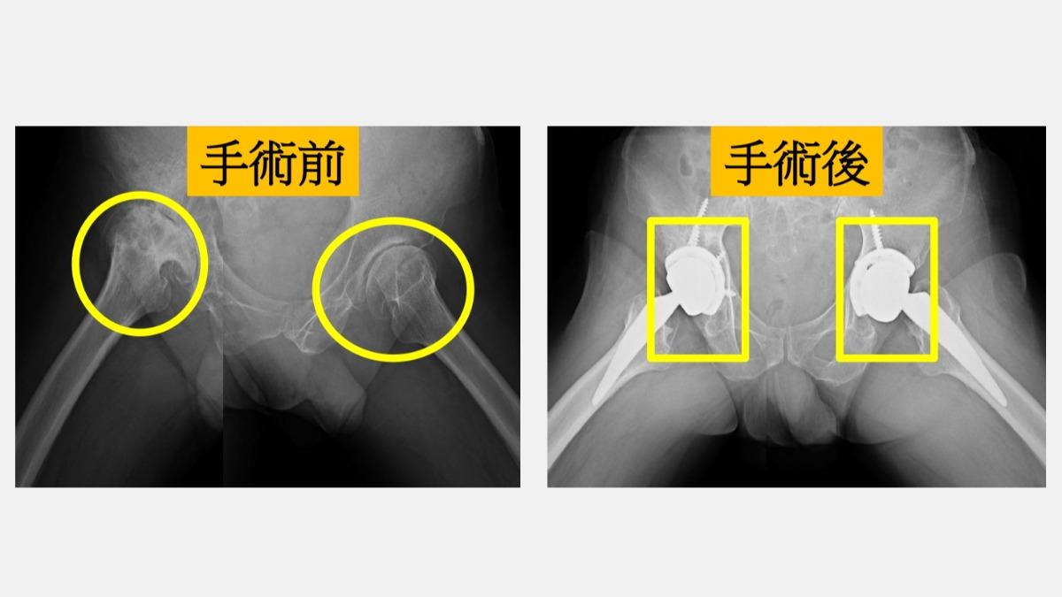 李男術後6小時就開始用助行器下床活動，2個月後順利回到工作崗位。（圖／大里仁愛醫院提供）
