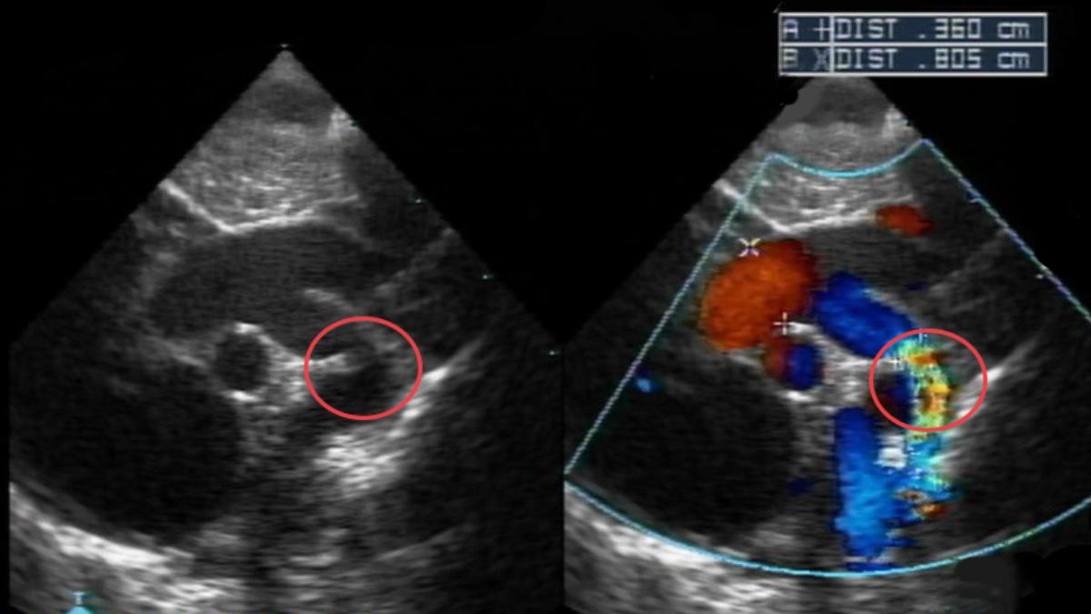 超音波檢查意外找到男寶寶主動脈弓有一明顯縮窄處。（圖／澄清醫院中港分院提供）