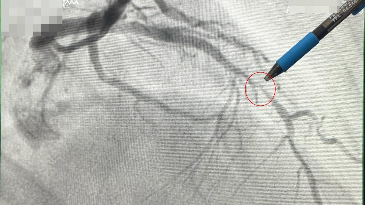 黃祺耀說明，男子血管阻塞，研判是急性心肌梗塞。（圖／大甲李綜合醫院提供）