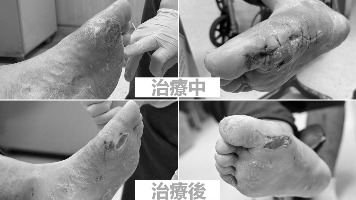 體重高達120公斤林姓男子，因忽視三高，引起糖尿病神經病變引發的深層足部潰瘍。（圖／亞大附醫提供）