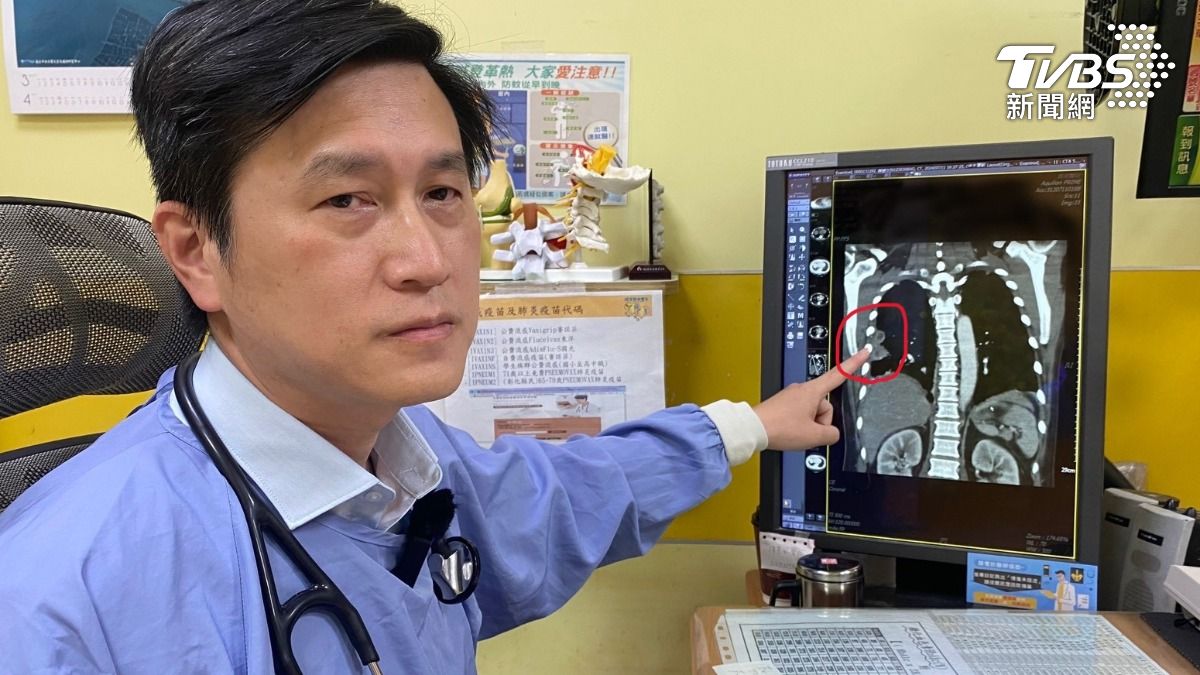 員榮醫院醫療副院長涂川洲表示，患者感上類鼻疽菌，肺部有兩處膿瘍。（示意圖／TVBS）