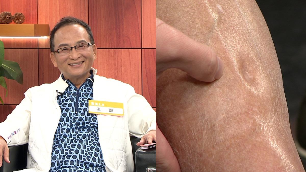 孔鏘右腿嚴重水腫。（圖／年代提供）