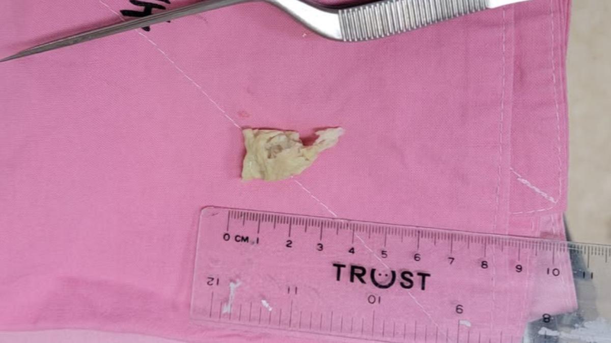 病患鼻子被一坨衛生紙塞住。（圖／翻攝自「耳鼻喉科 陳世璽醫師」臉書）