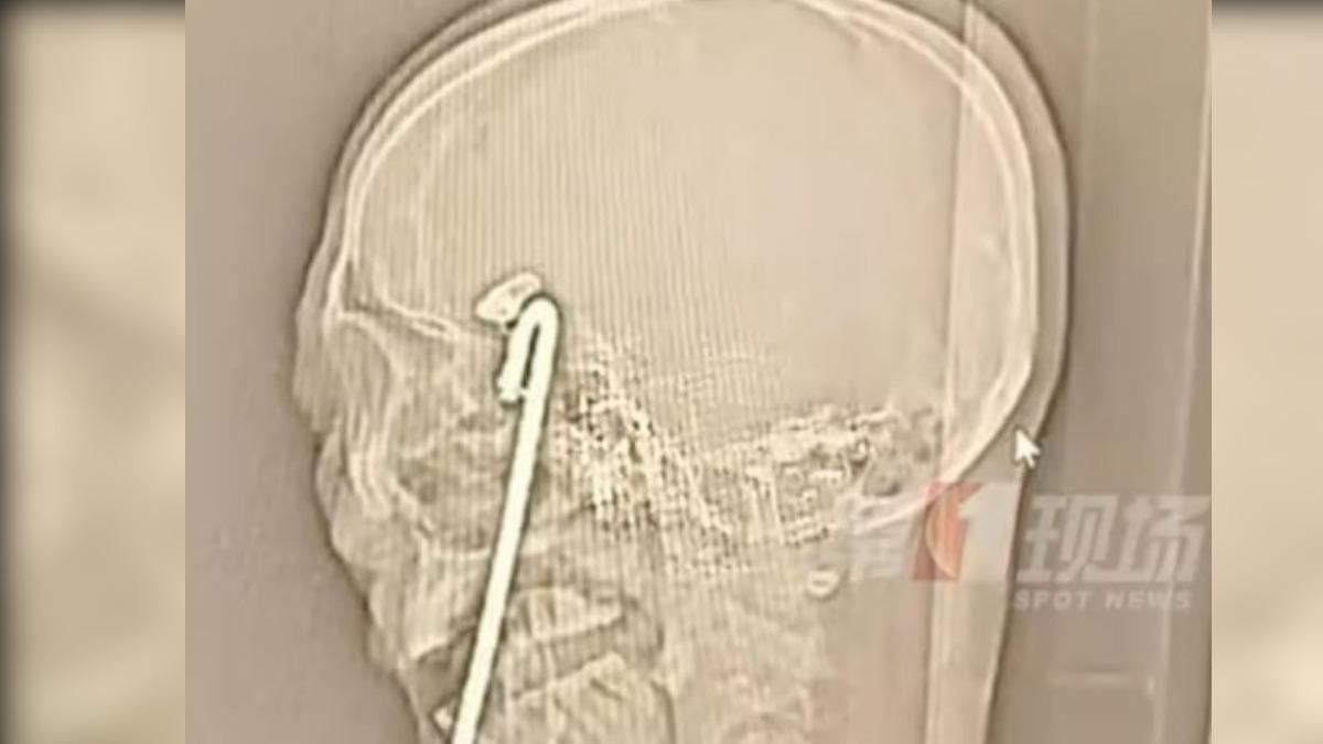 鐵棒從中國男子的口腔刺入，他當場流血如注。（圖／取自微博）