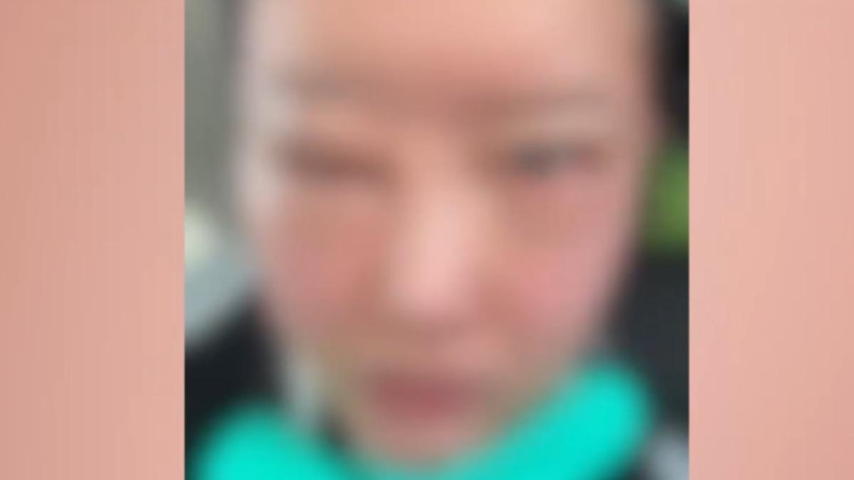 吳悅菡貼出自己雙眼發紅紅腫的照片。（圖／翻攝自吳悅菡 微博）