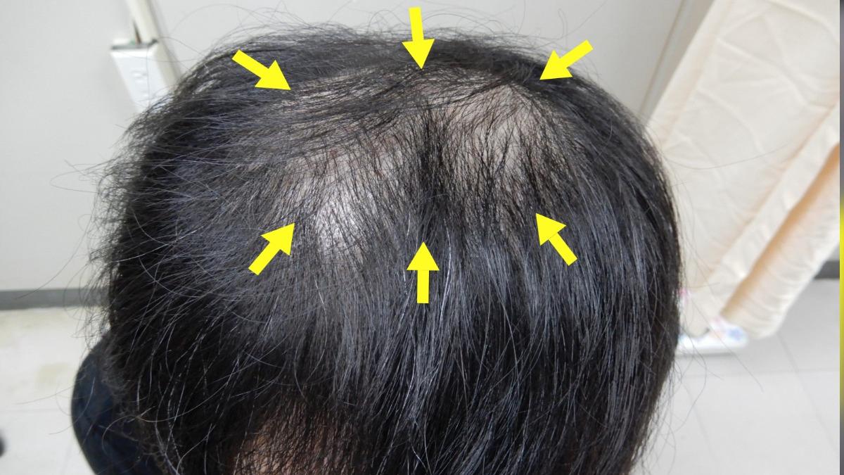 台中男近幾個月突然狂掉髮，最終查出是梅毒所致。（圖／澄清醫院中港分院提供）