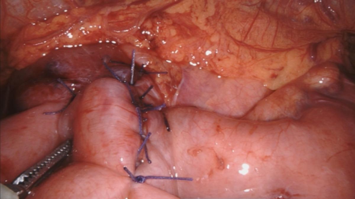 手術直接將十二指腸阻塞的前段處打開，與空腸做吻合。（圖／梧棲童綜合醫院提供）