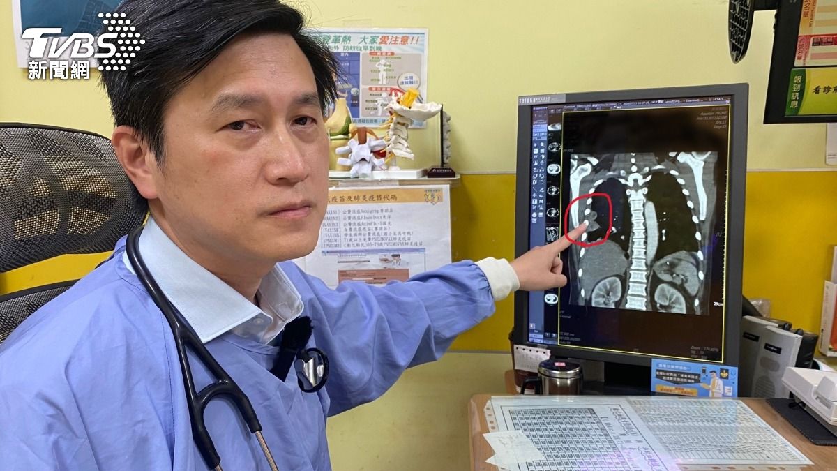 男子當時肺部已出現嚴重膿瘍，需緊急手術清創並送檢，確認感染來自東南亞常見但在台少見的類鼻疽桿菌