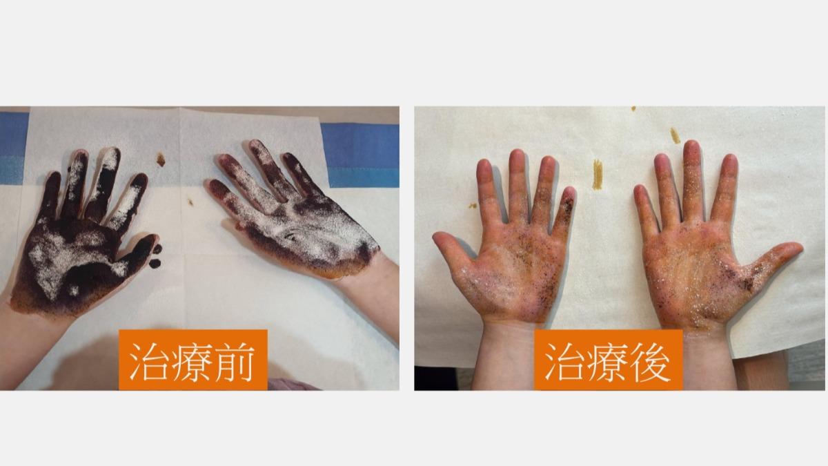 一名國中少女罹患「腋下多汗與輕度狐臭合併代償性手汗」，手抹碘澱粉秒冒紫色斑塊。（圖／大里仁愛醫院）