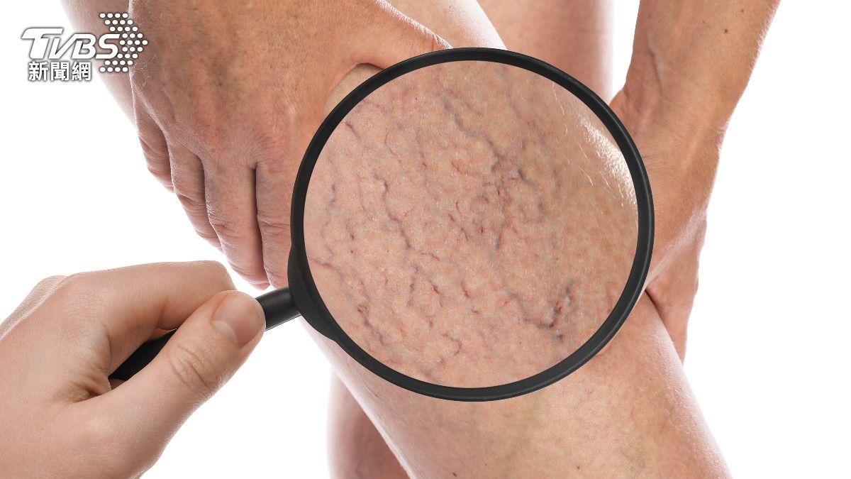 靜脈曲張的病因包括久坐、久站、抽菸或過重。（示意圖／達志影像shutterstock）