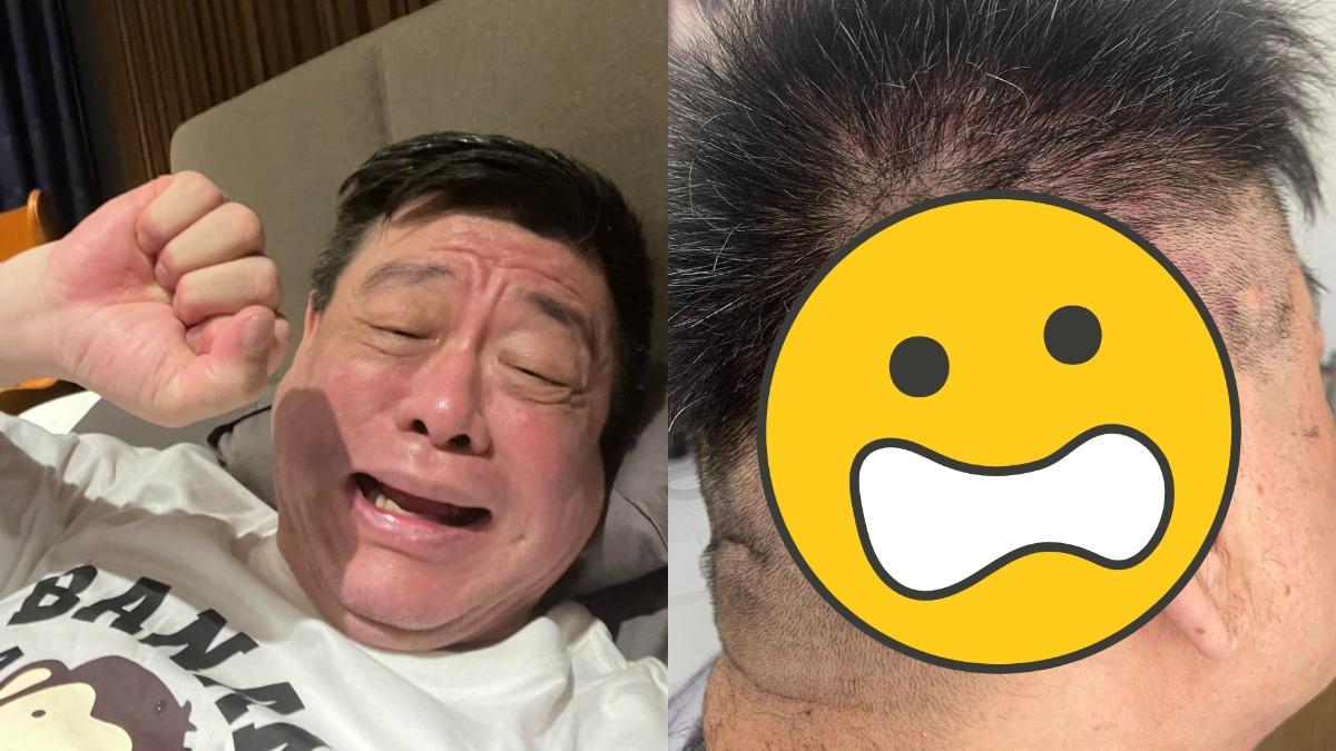 孫德榮分享自己頭皮出現問題。（圖／翻攝自孫腫來了 臉書）