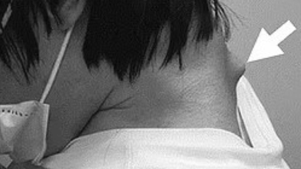男子的脖子甚至長出突起物。(圖/翻攝自JOS Case Reports) 男子的脖子甚至長出突起物。(圖/翻攝自JOS Case Reports)