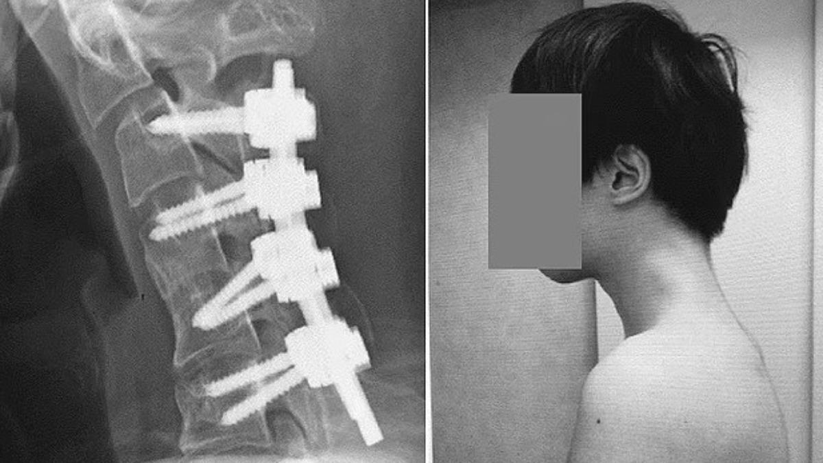男子動手術6個月後,奇蹟似地能夠輕鬆地將頭部保持在正常水平位置。(圖/翻攝自JOS Case Reports) 男子動手術6個月後,奇蹟似地能夠輕鬆地將頭部保持在正常水平位置。(圖/翻攝自JOS Case Reports)