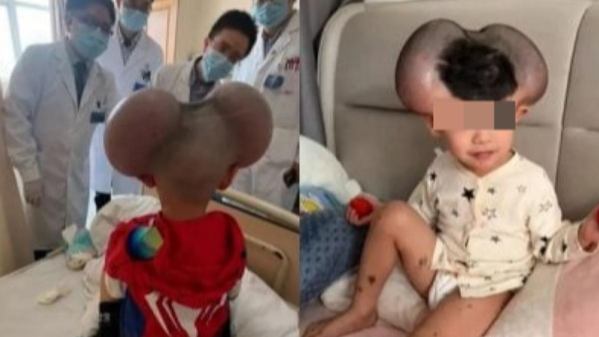 先天性巨痣-先天性巨大黑色素痣-琪寶巨痣-巨大黑色素痣-巨大黑色素痣產檢