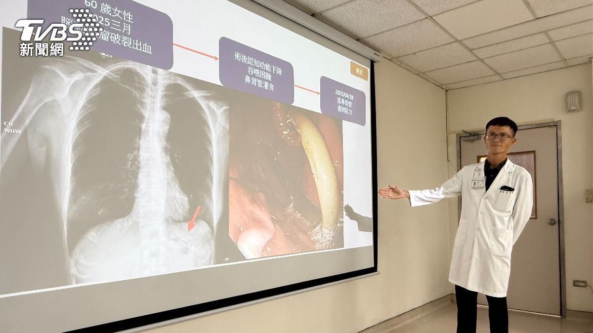 吳明駿醫師利用無痛胃鏡與異物夾解開患者胃內揪結的鼻胃管。（圖／TVBS）