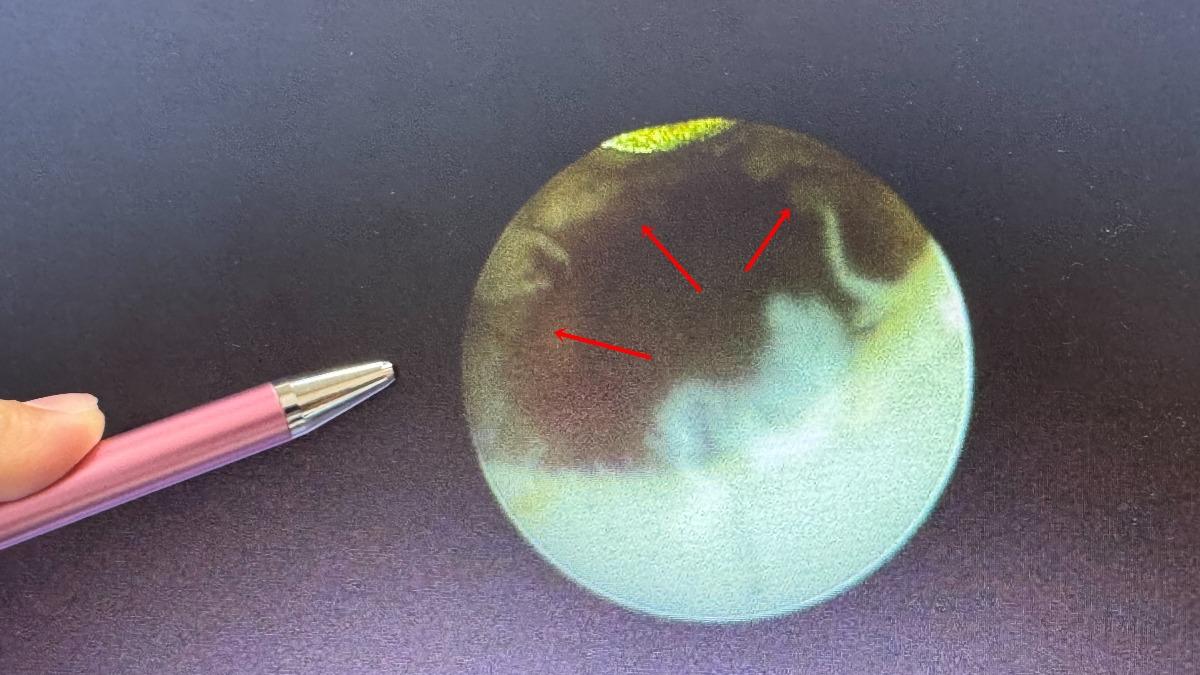 工人距離尿道口2公分的地方,布滿了0.5公分腫瘤(霧狀箭頭處),腫瘤延伸至少4公分。(圖/大甲李綜合醫院提供)