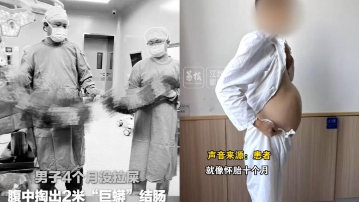便祕4個月！40歲陸男挺大肚　醫挖出2公尺「巨蟒結腸」