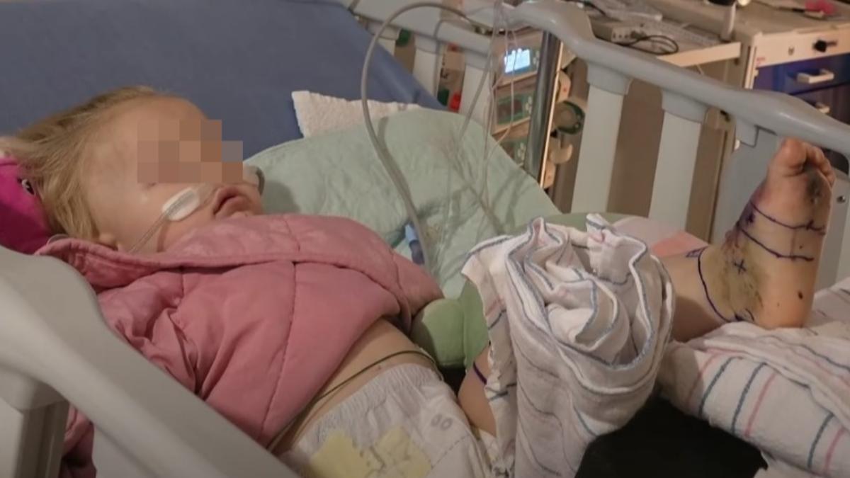 美1歲女童被響尾蛇咬　腳掌嚴重發黑「狂打30瓶血清」救命