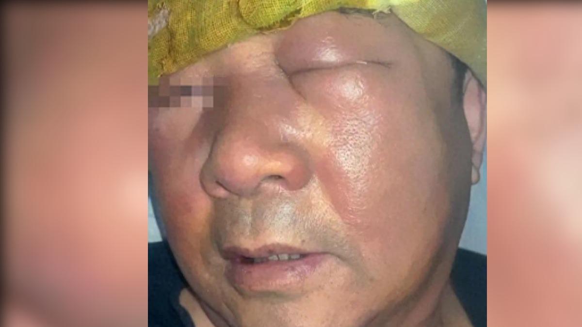 66歲陸男挖鼻孔挖出病！臉腫到像豬頭　醫示警：這些人最危險