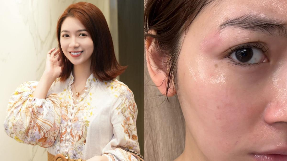 大馬女星「台灣髮廊遭燙傷」！200度捲髮棒重擊臉　怒控業者神隱