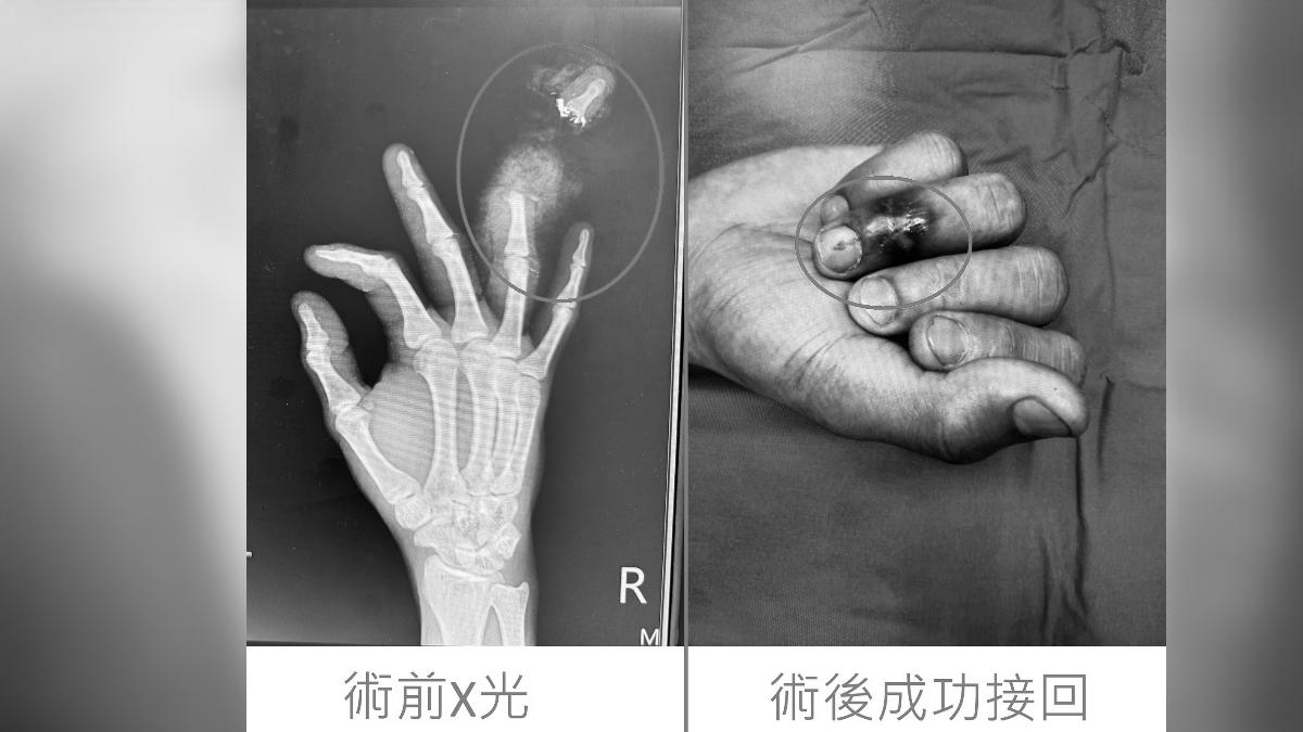 阿里於工廠打掃機台時，不慎誤觸開關，結果左手無名指末節遭捲入。（圖／烏日林新醫院提供）