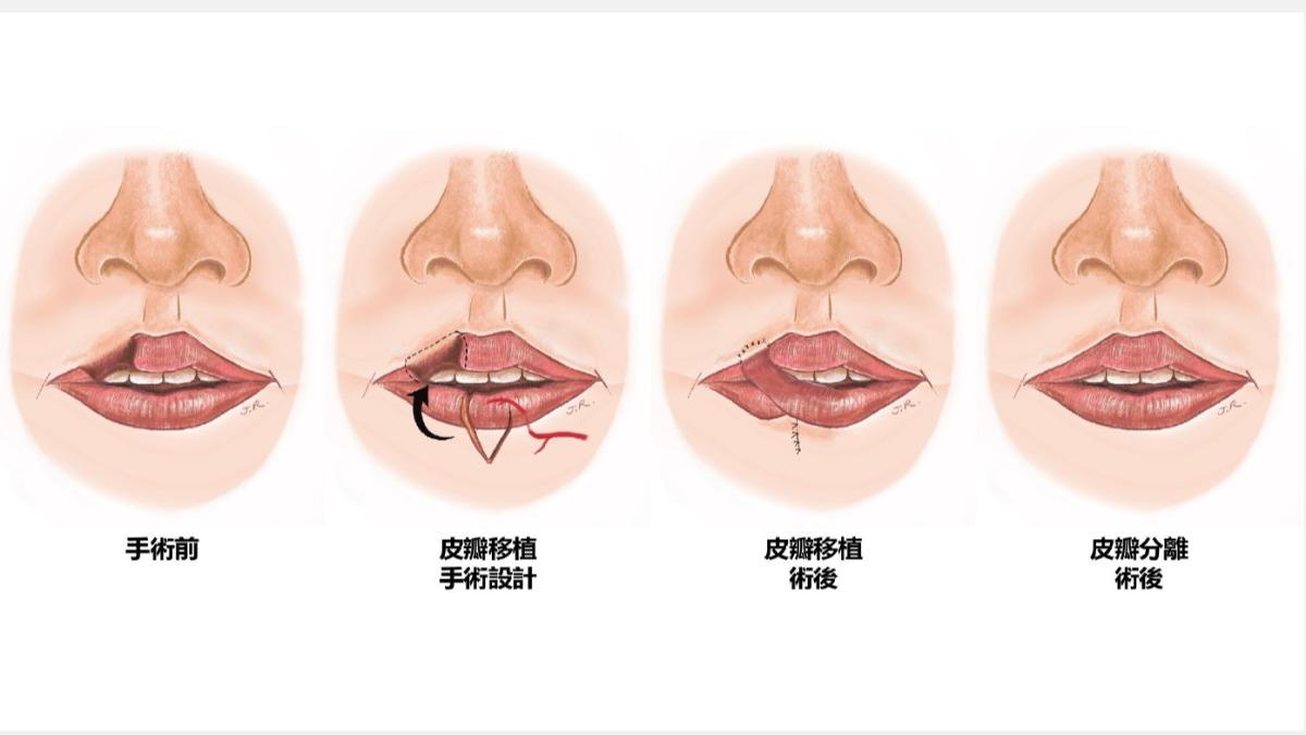 醫療團隊用下唇中央取對稱皮瓣，移植至上唇缺損處。（圖／大里仁愛醫院提供）