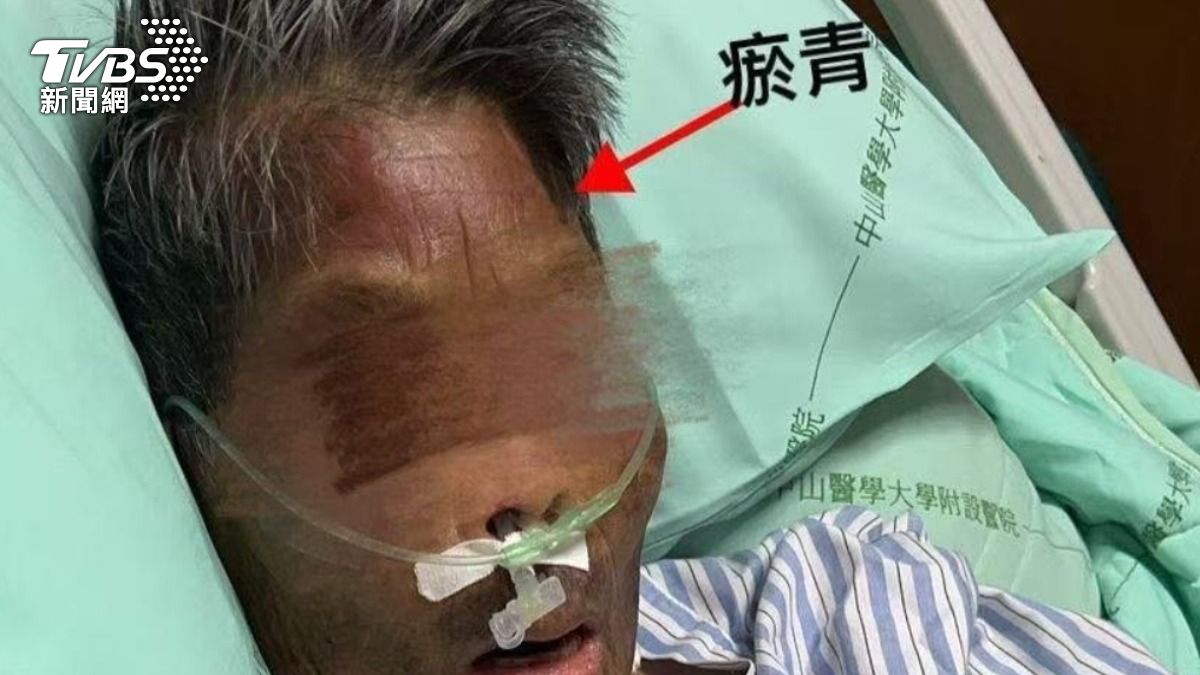 阿嬤臉上有多處瘀青。（圖／TVBS）