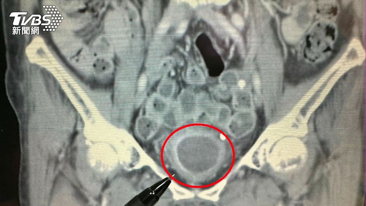經手術及放射治療後,陳女士膀胱狀況恢復良好也無腫瘤。(圖/TVBS)