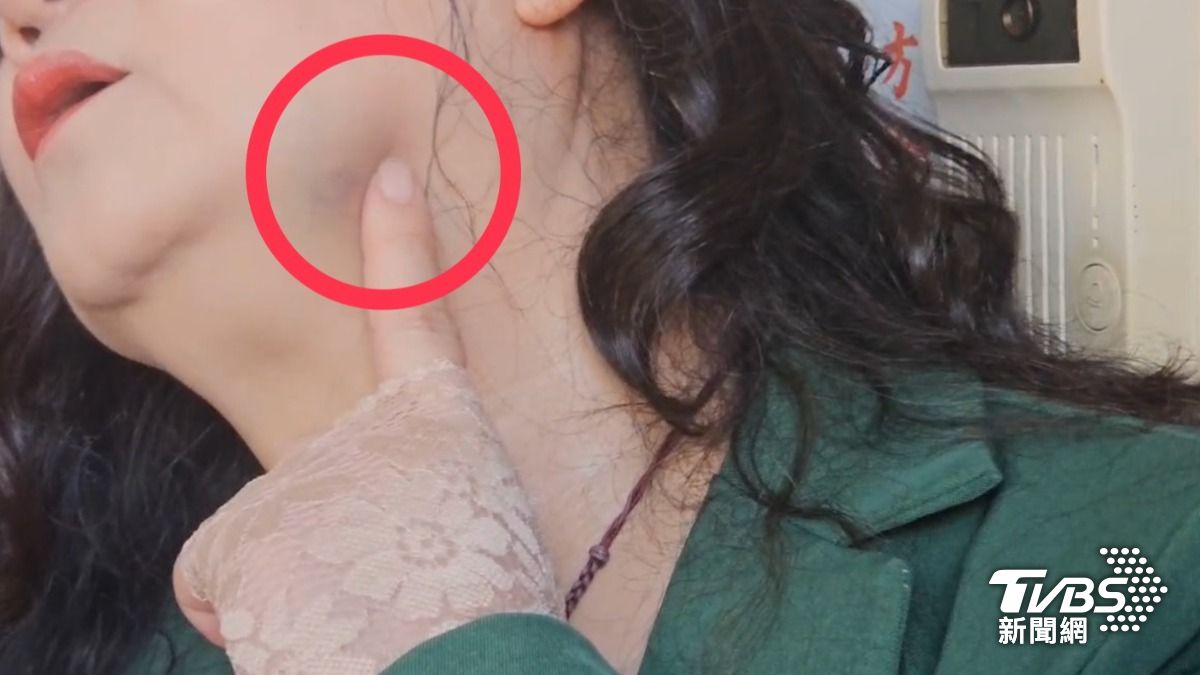女房東抬頭秀出下巴瘀青，反告樋口夫妻傷害。（圖／TVBS）