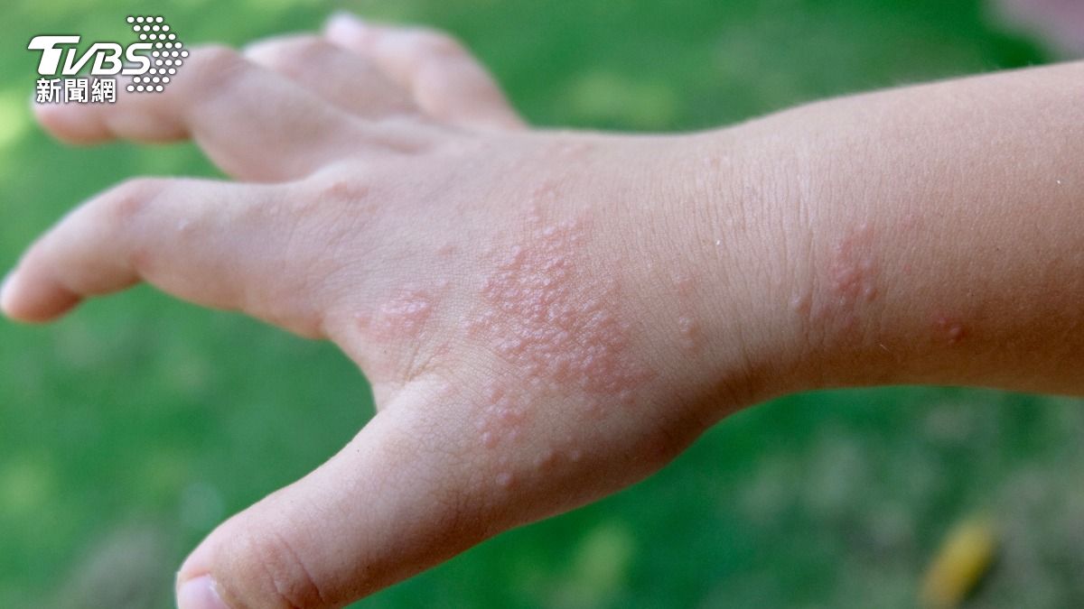 手腳冒小水泡超癢！「汗皰疹」1體質是真兇　日常5招預防