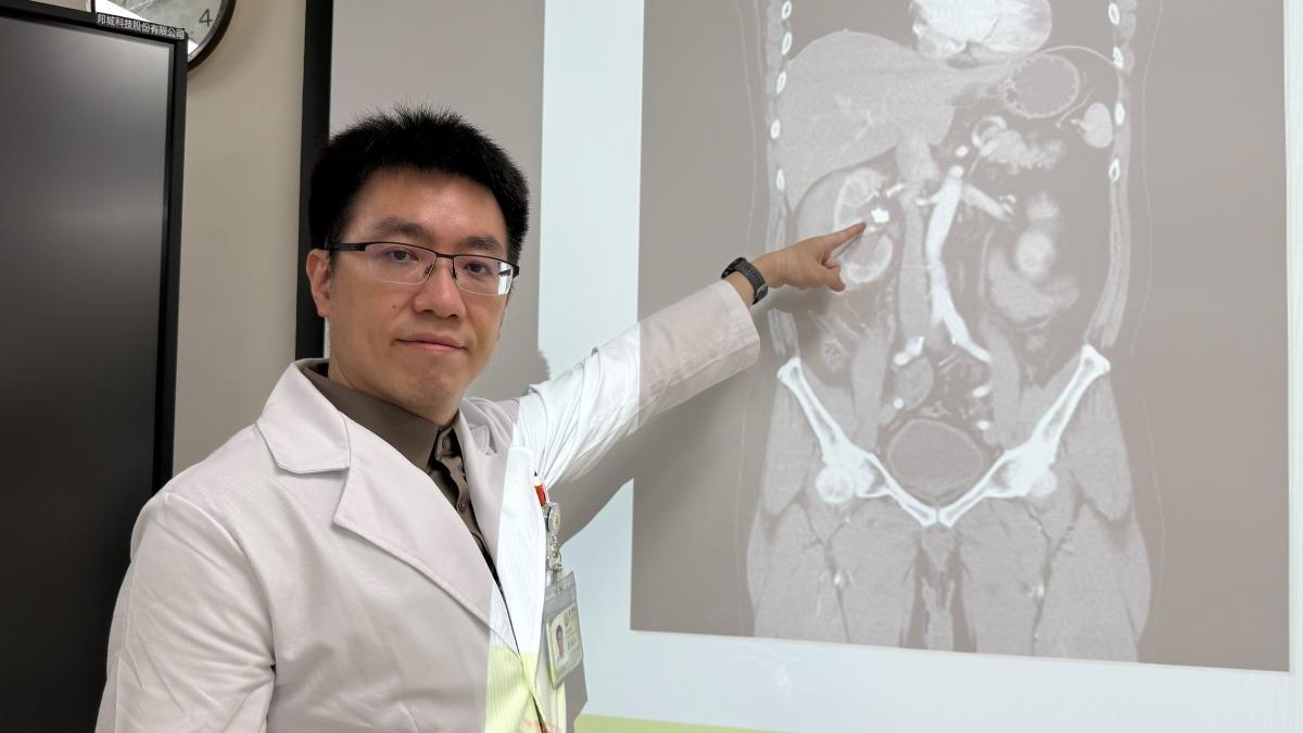 運氣不好的吳男不僅碎石不成，腎臟還被震到出血。（圖／台中醫院提供）