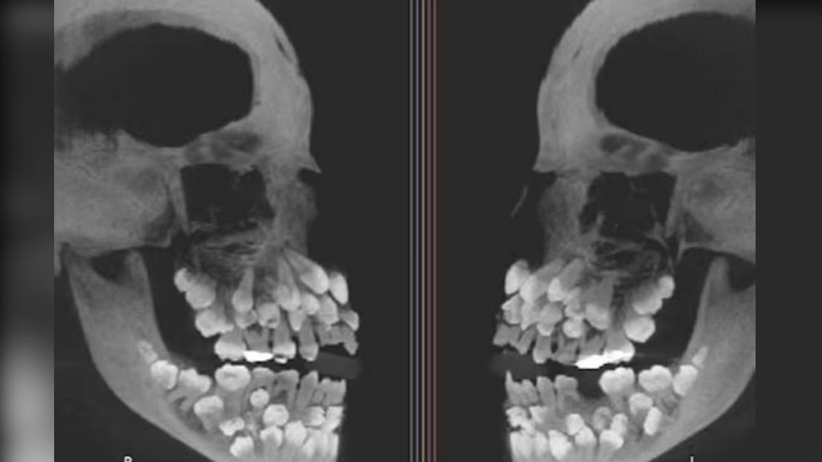 巴西女童拔牙就診　X光一照「竟有81顆牙」嚇壞牙醫