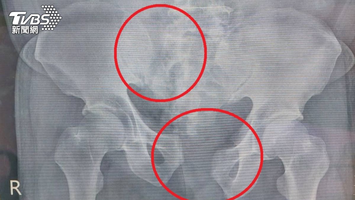 苗栗翁墜3樓骨盆碎裂血流不止　心跳飆150瀕死多醫搶命
