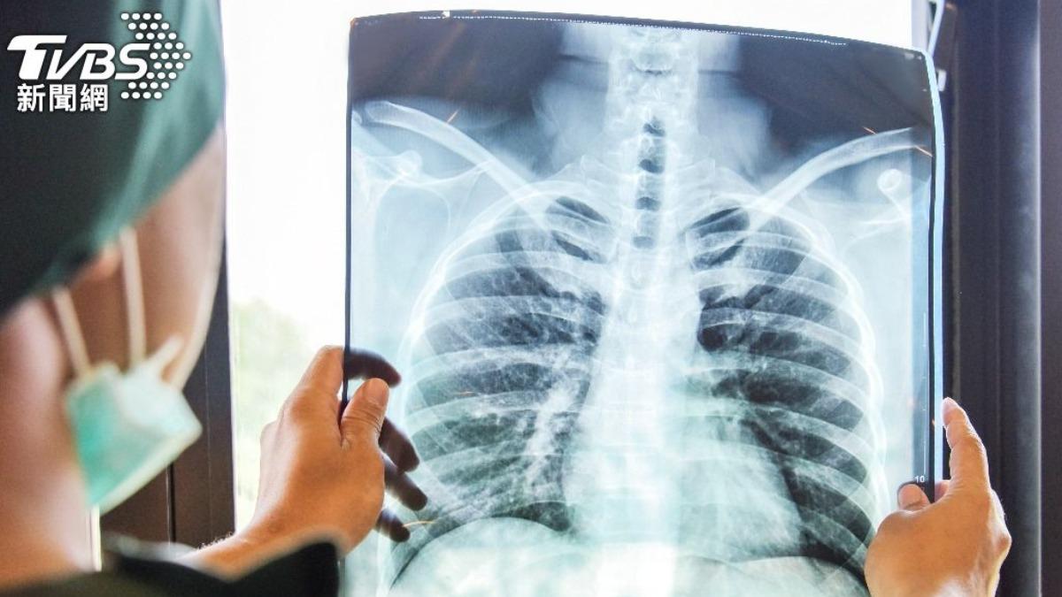 肺癌治療後「腫瘤長大1.5倍」！醫曝真相：不是壞消息