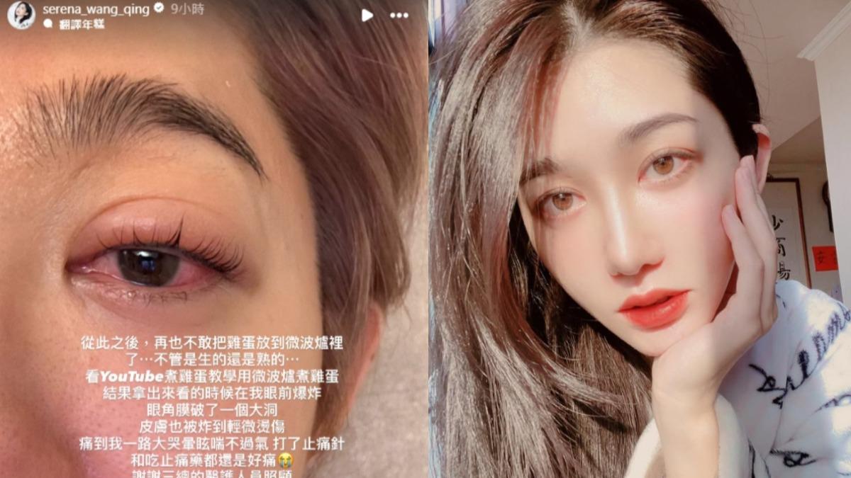 王晴「角膜破大洞」驚悚！左眼被炸傷劇痛送醫　微波雞蛋爆炸
