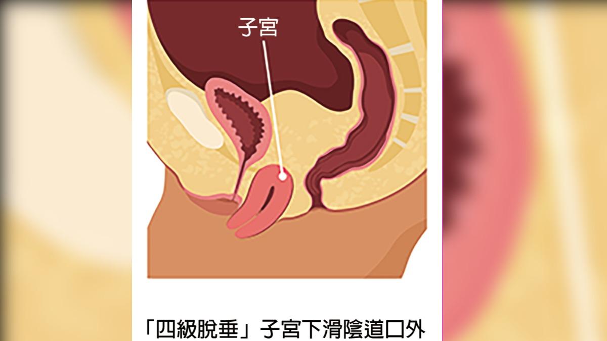 走路卡卡！三寶媽忍10年　「子宮脫垂」露出5公分急開刀
