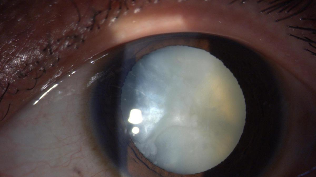 台中一名40歲的徐姓女子右眼遭撞擊，三個月後得白內障瀕失明。（圖／大里仁愛醫院提供）