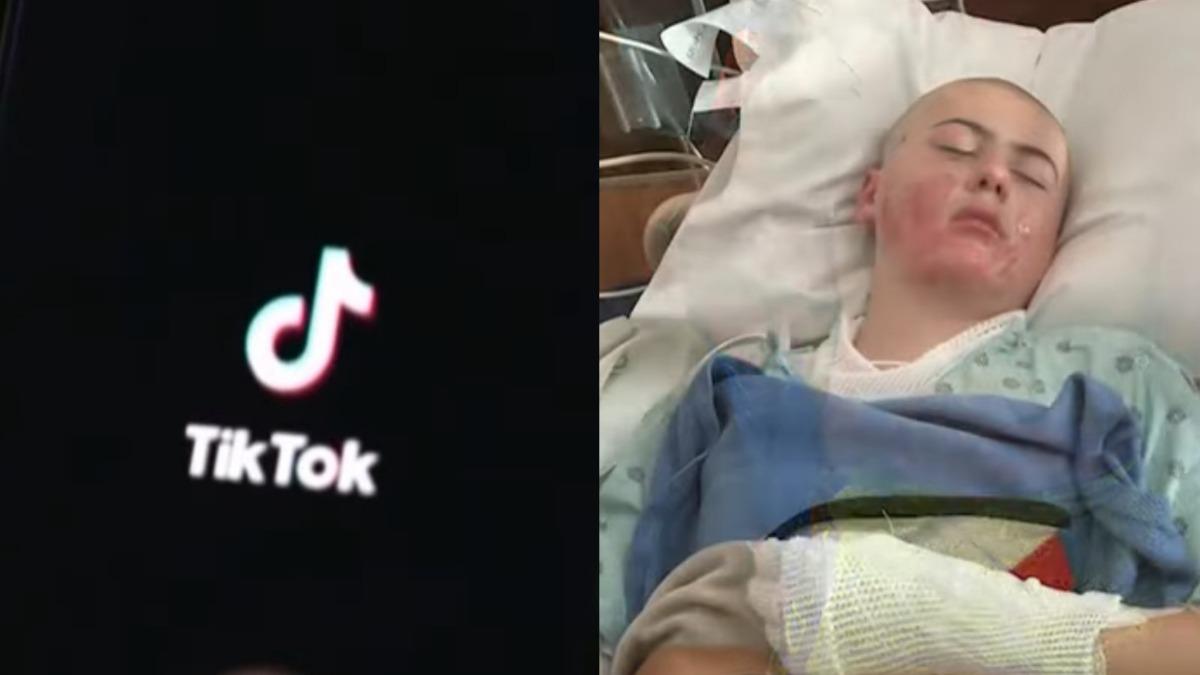 美12歲男童模仿TikTok實驗！衣服起火全身嚴重燒傷慘住院