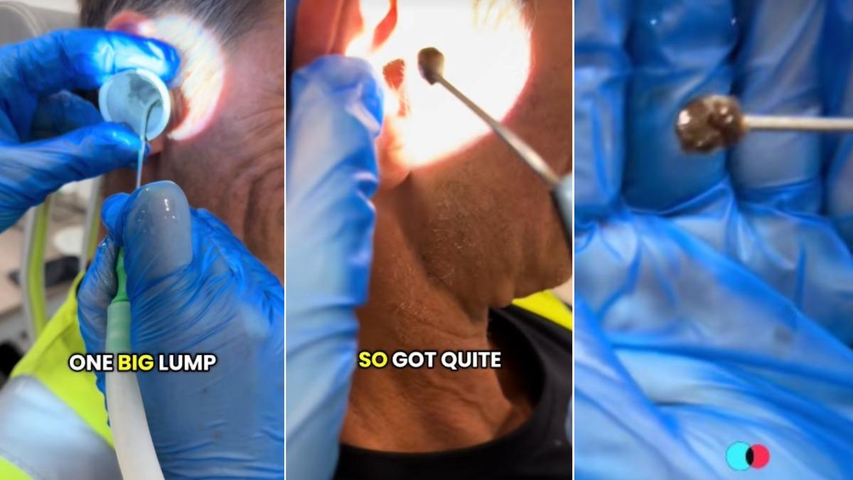 英國有名被耳鳴困擾10年的男子就醫，隨後被醫生從耳內挖出「巨大耳屎」。（圖／翻攝自TikTok@stevenhalehearing）