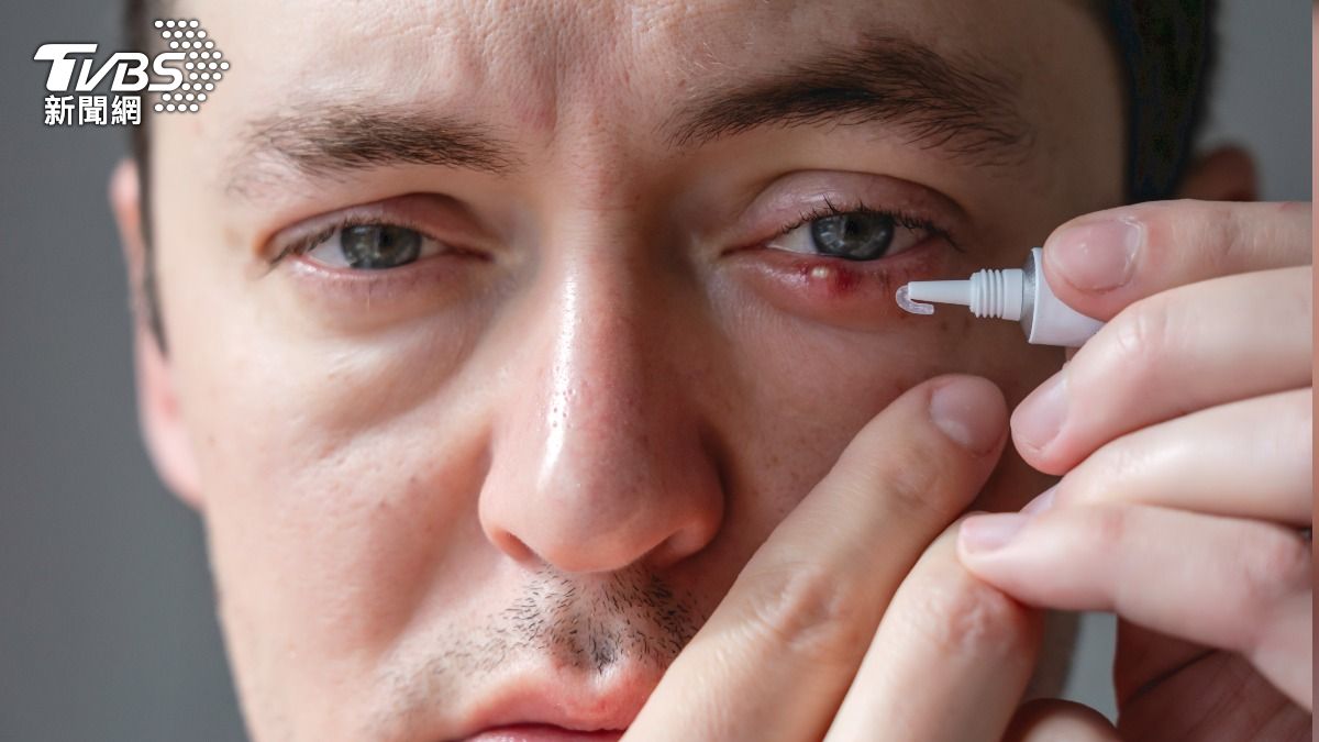 《Social Lab社群實驗室》公布九大針眼原因。（示意圖／shutterstock達志影像）