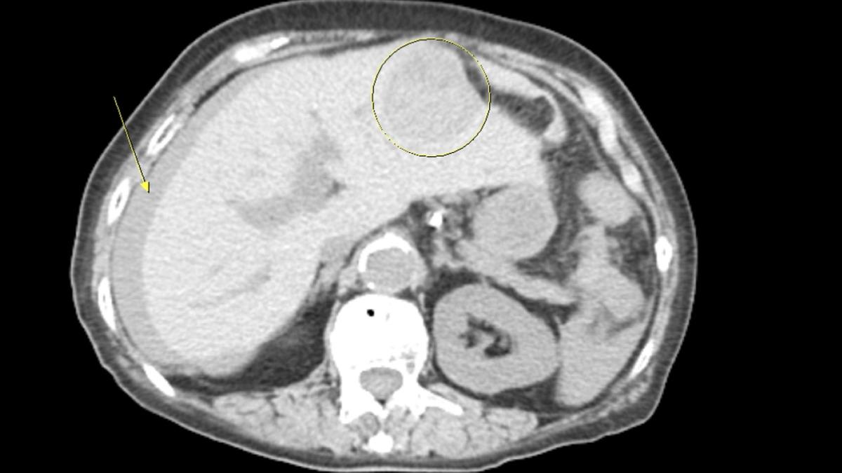 台中一名阿嬤不知自己罹癌，左肝邊緣肝腫瘤破裂（圓圈處），血水流進腹腔（箭頭處）引起腹痛。（圖／澄清醫院中港院區提供）