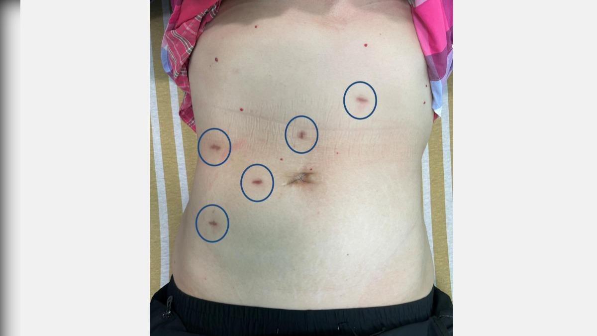 恐怖大腸癌成因未知！婦陪尪健檢反成主角　四期存活率30％
