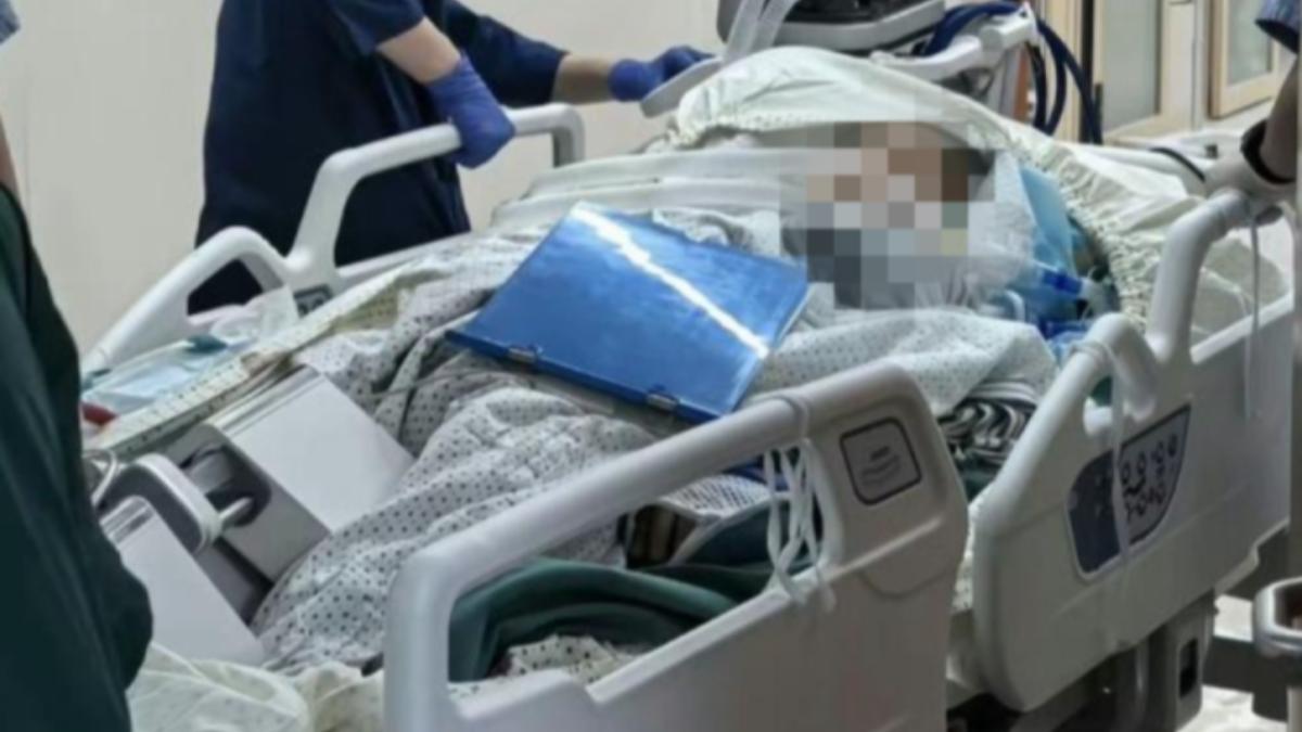 化骨水,氫氟酸,化骨水氫氟酸,化骨水腐蝕,,葉克膜