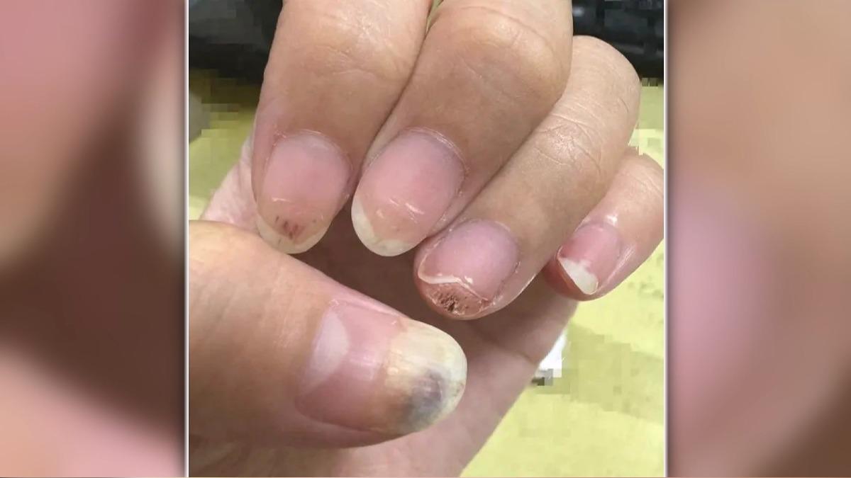 美甲變爛甲？女控「器材不乾淨」染病毒疣　台中店家否認：願陪同就醫