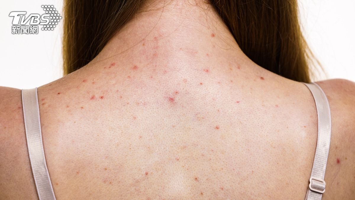 背痘的成因複雜，通常為毛孔堵塞、背部皮脂腺旺盛等。（示意圖／shutterstock 達志影像）