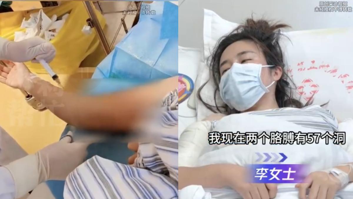 中國一名女子打溶脂針，導致手臂潰爛。（圖／翻攝自微博小莉幫忙）